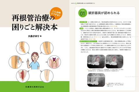 こんな時どうする？再根管治療の困りごと解決本