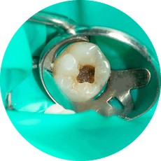 生活歯髄保存療法
