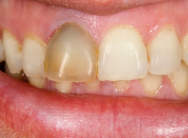 前歯の黒ずみ